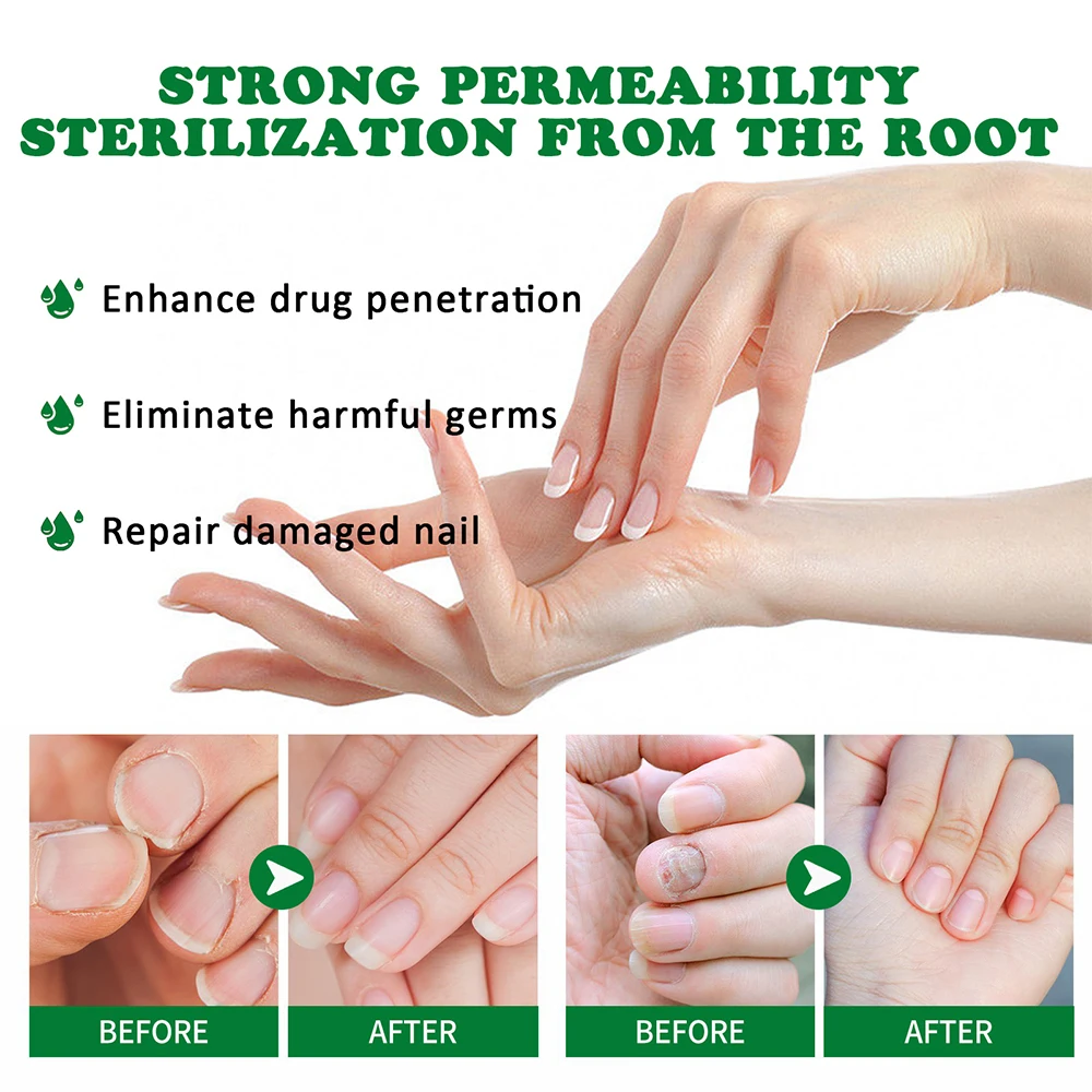 Fungus NailLaser Treatment Device Repair Toenail Fingernail Essential Oil Onychomycosis Treat Toenail Nail Fungal Treatment
