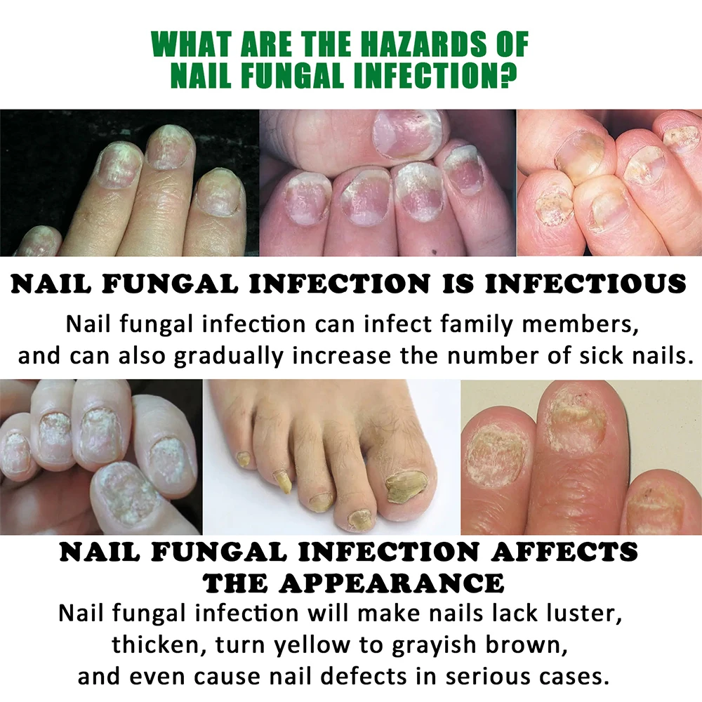 Fungus NailLaser Treatment Device Repair Toenail Fingernail Essential Oil Onychomycosis Treat Toenail Nail Fungal Treatment